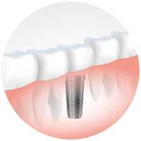 Implantes